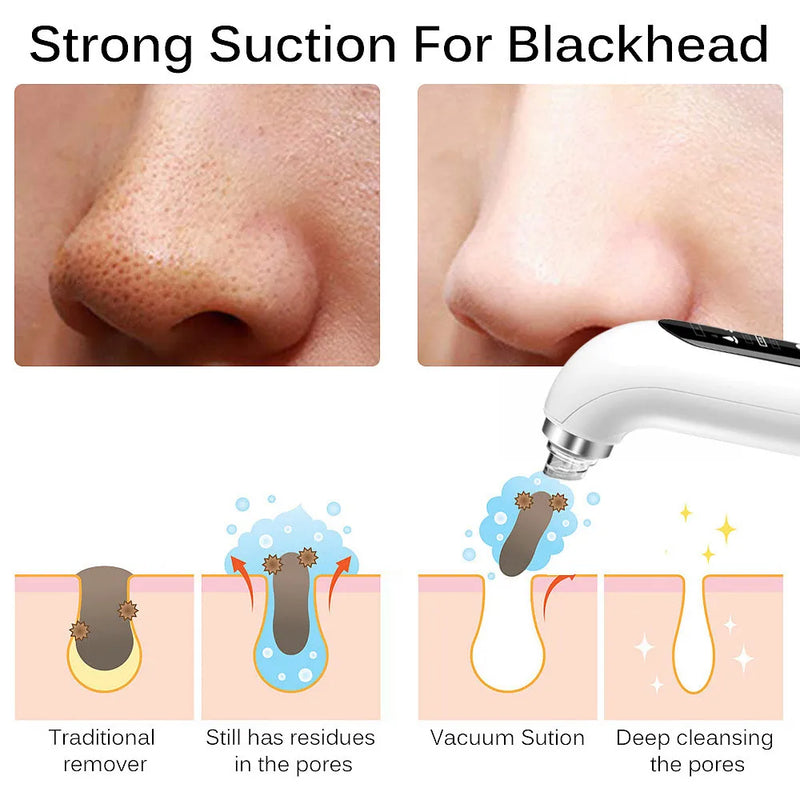 Pore Cleanse Pro Blackhead Vacuum